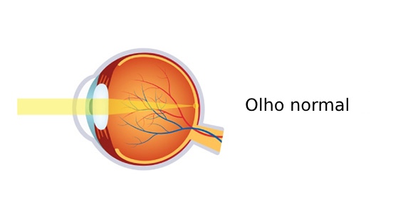 Representação do funcionamento de um olho normal