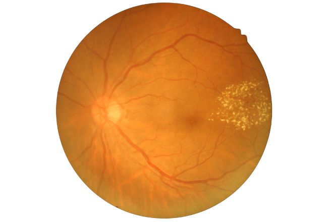 Retinografía de uma retinopatia diabética que causa baixa visão