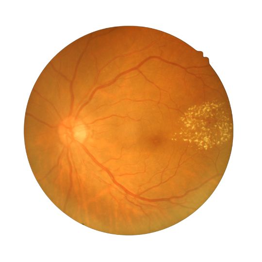 Retinografía de uma retinopatia diabética que causa baixa visão