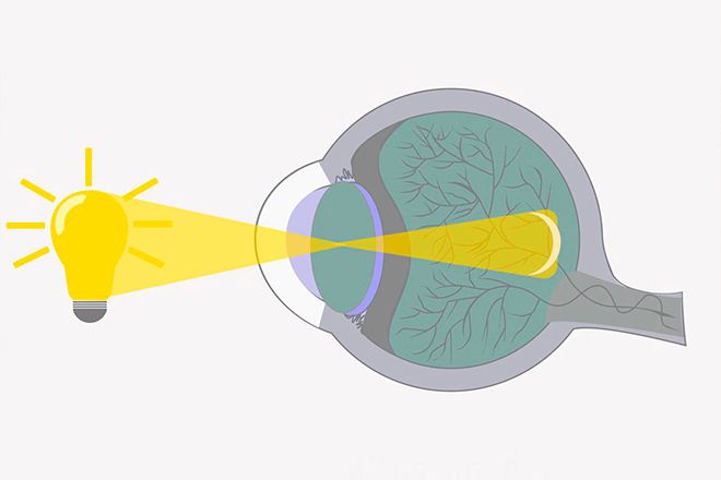 Esquema refrativo de um olho com miopia