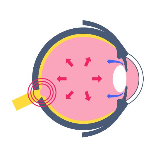 Esquema explicativo sobre a press&atilde;o intraocular