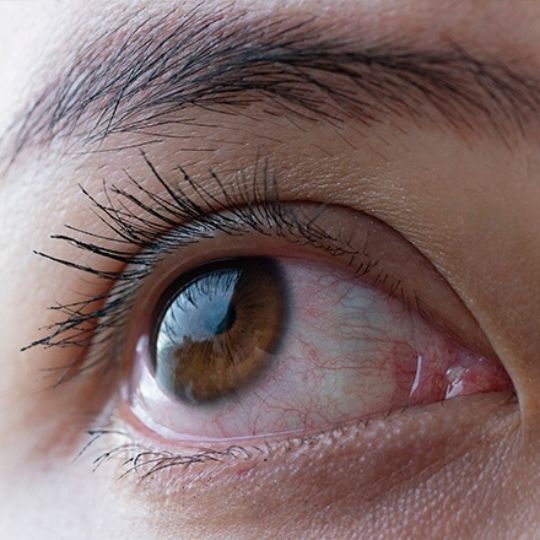 Primeiro plano de um olho com a tens&atilde;o ocular alta