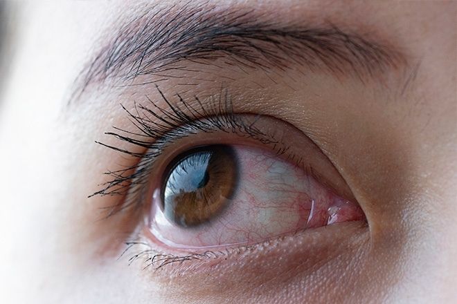 Primeiro plano de um olho com a tens&atilde;o ocular alta