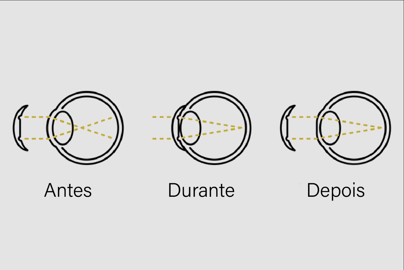 Explicação do funcionamento das lentes de contacto de ortoqueratologia